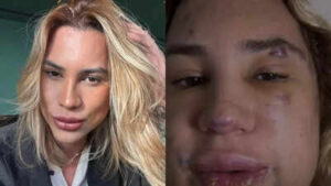 Brazilian influencer dies at 31 after fox eyes surgery complications know what is it health risks an.jpeg