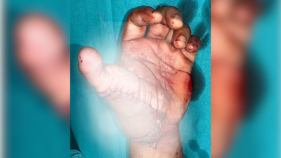 Doctors reconstruct thumb from 20 year old mans amputated leg in delhi.jpg