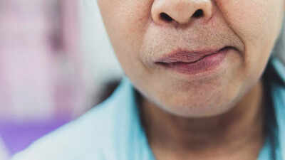 Facial paralysis warning signs key causes symptoms and prevention steps you need to know.jpg