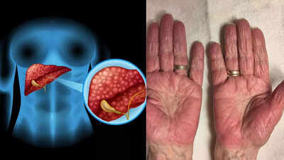 Liver damage warning signs visible on your hands heres what you need to know.jpg