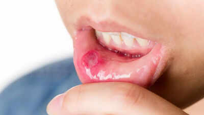 Identifying the early signs of mouth cancer causes diagnosis and why early detection matters.jpg