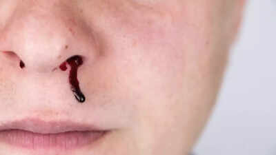 Why your nose bleeds when you sneeze and how to stop it common causes risks and treatment.jpg