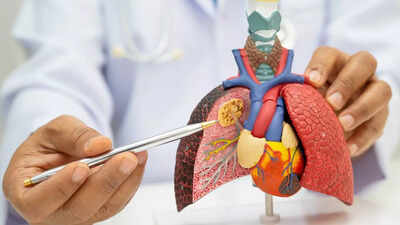 Worlds first lung cancer prevention vaccine trial funded with 206 million to stop cancer before it s.jpeg