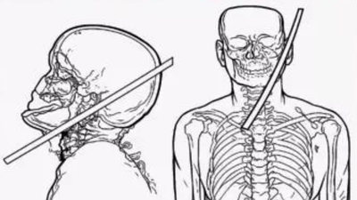 For representation based on ct scan39s front and lateral views.jpg